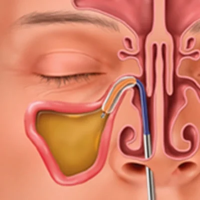 nova-balloon-sinuplasty